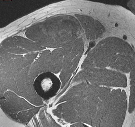 Figure 2 for case rectus femoris indirect head proximal myotendinous junction tear with hematoma( RID2698 )